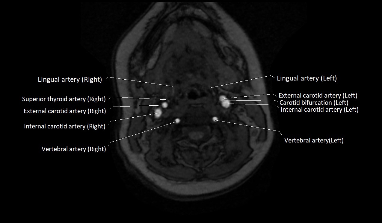 Carotid artery anatomy axial 3T image 27.jpg
